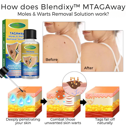 Blendixy™ TAGAway Moles & Warts Removal Solution