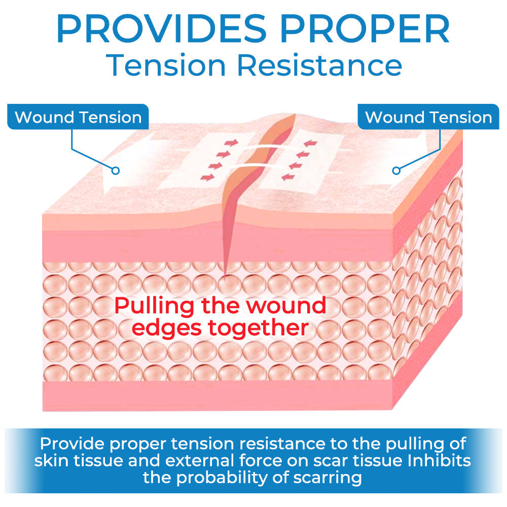 GFOUK™ StitchFree Closure Device